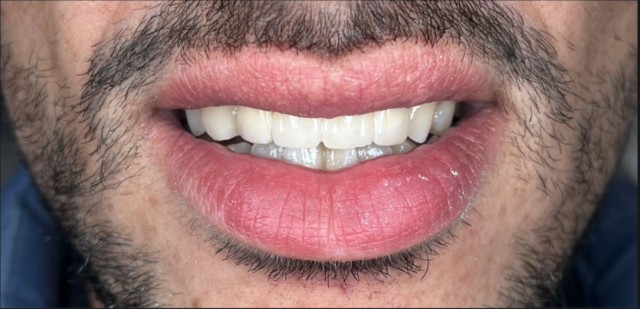 Avant traitement soins dentaires BioDental Annaba